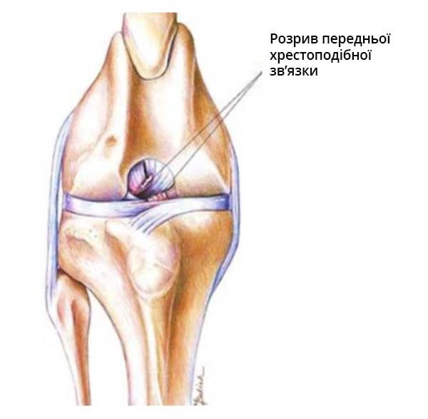 Пряма проєкція колінного суглоба - показано розрив ПХЗ.