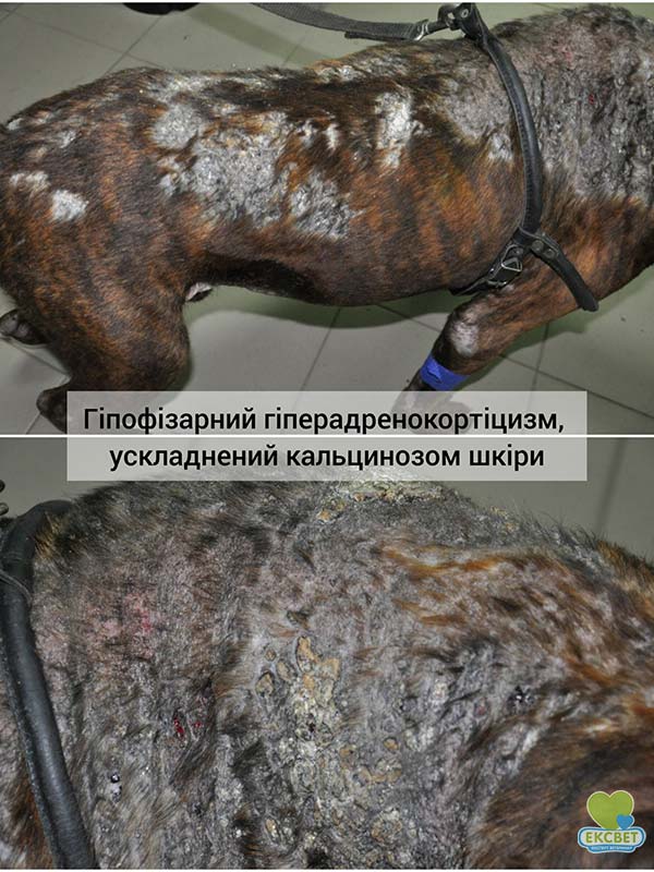 Гіпофізарний гіперадренокортицизм, ускладнений кальцинозом шкіри