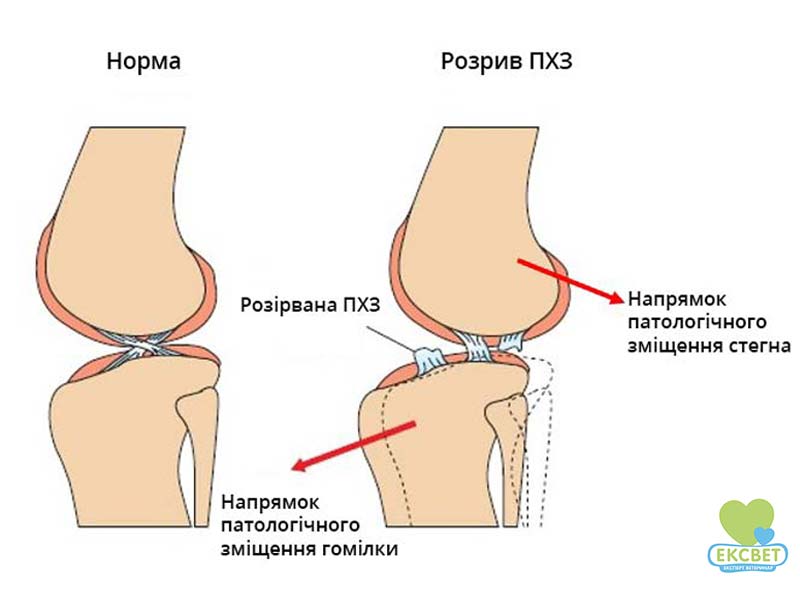 Розрив ПХЗ.