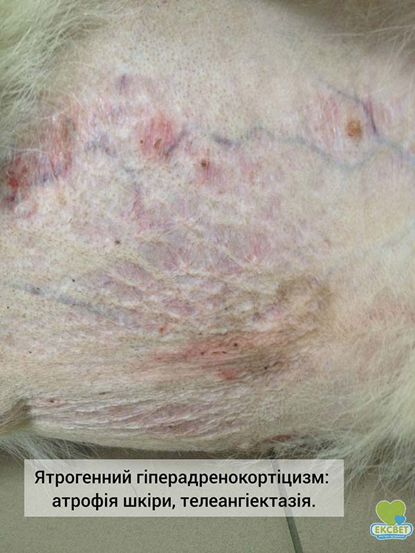 Ознаки гіперадренокортицизму - атрофія шкіри, телеангіектазія