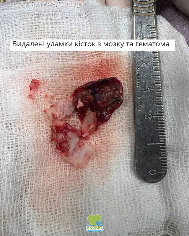 Вилучені уламки кісток черепа - фрагмент операції