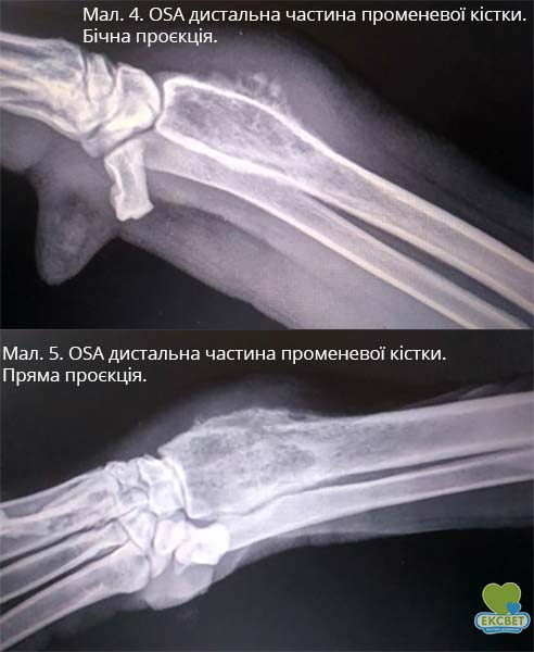 OSA дистальна частина променевої кістки.