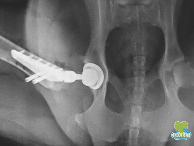 Протезування кульшового суглоба за ліцензією KYON