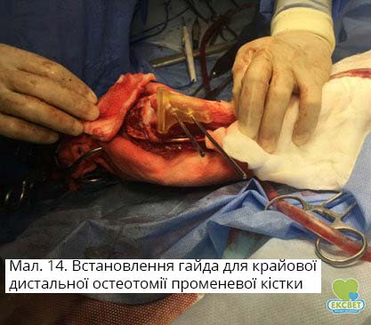 Встановлення гайда для крайової дистальної остеотомії променевої кістки