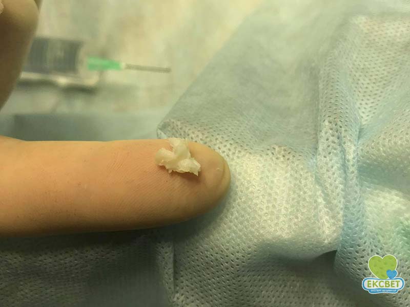 Видалення грижового компонента, хірургічне лікування міжхребцевої грижі