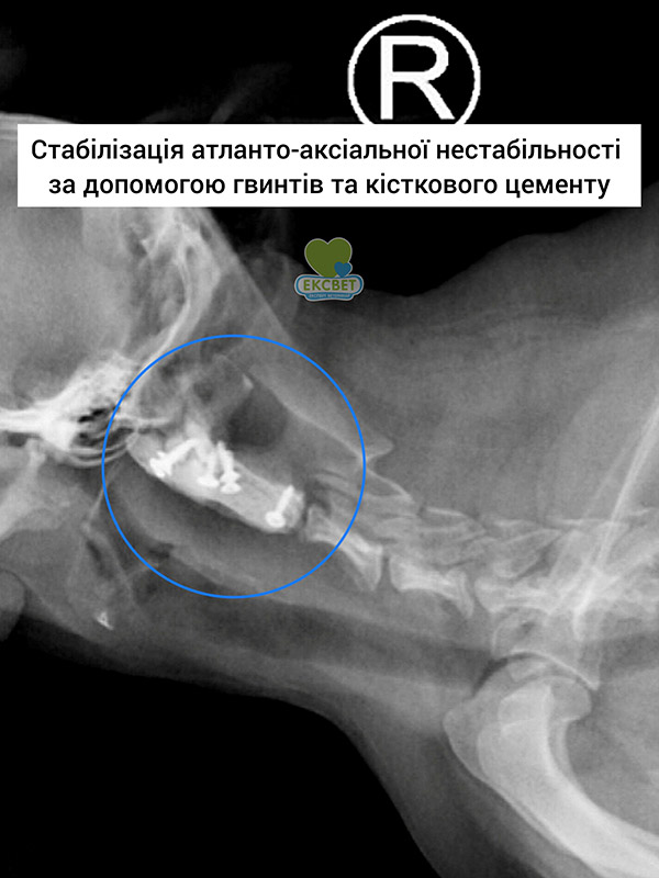 Стабілізація атланто-аксіальної нестабільності за допомогою гвинтів та кісткового цементу - стабілізація першого і другого шийних хребців
