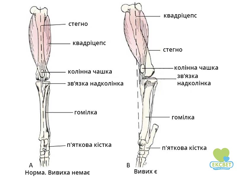 А - нормальне положення колінної чашки.&nbsp;Б - медіальний (внутрішній) вивих колінної чашки.