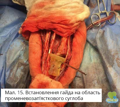 Встановлення гайда на область променевозап’ясткового суглоба